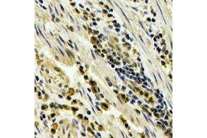 Immunohistochemical analysis of STAU1 staining in human esophageal cancer formalin fixed paraffin embedded tissue section. (STAU1/Staufen antibody)