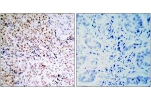 Immunohistochemistry analysis of paraffin-embedded human breast carcinoma, using Retinoblastoma (Phospho-Ser795) Antibody.