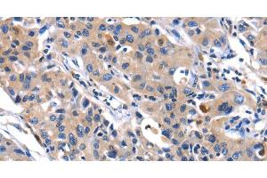 Immunohistochemistry of paraffin-embedded Human lung cancer tissue using MMP16 Polyclonal Antibody at dilution 1:40