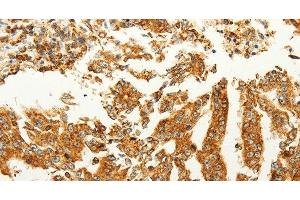 Immunohistochemistry of paraffin-embedded Human gastric cancer tissue using FZD6 Polyclonal Antibody at dilution 1:60 (FZD6 antibody)