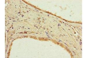 Immunohistochemistry of paraffin-embedded human prostate cancer using ABIN7169250 at dilution of 1:100 (PPP2R2D antibody  (Regulatory Subunit B))