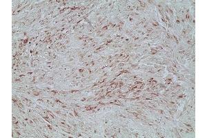 Immunohistochemistry analysis of human melanoma skin tissue using Melanoma marker (human) mAb (HMB45) (Ready-To-Use), (ABIN7211671). (Melanoma Marker antibody)
