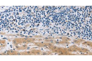 Immunohistochemistry of paraffin-embedded Human liver cancer using MUC20 Polyclonal Antibody at dilution of 1:40 (MUC20 antibody)