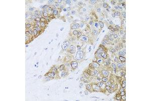 Immunohistochemistry of paraffin-embedded human lung cancer using CHD1 antibody at dilution of 1:100 (x40 lens).
