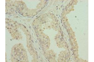 Immunohistochemistry of paraffin-embedded human prostate cancer using ABIN7146065 at dilution of 1:100 (CLEC3A antibody  (AA 23-197))