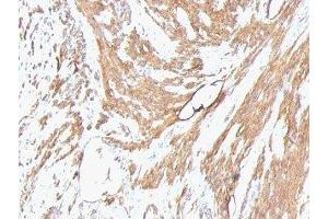 Formalin-fixed, paraffin-embedded human leiomyosarcoma stained with pan Muscle Actin antibody (Pan Muscle Actin antibody)