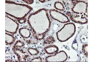 Immunohistochemical staining of paraffin-embedded Carcinoma of Human thyroid tissue using anti-ALG2 mouse monoclonal antibody. (ALG2 antibody)