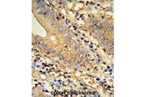 Formalin-fixed and paraffin-embedded human colon carcinoma reacted with TSPAN33 Antibody (C-term), which was peroxidase-conjugated to the secondary antibody, followed by DAB staining. (TSPAN33 antibody  (C-Term))