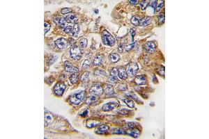 Formalin-fixed and paraffin-embedded human lung carcinoma tissue reacted with GRB2 Antibody , which was peroxidase-conjugated to the secondary antibody, followed by DAB staining. (GRB2 antibody  (AA 187-216))