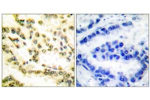 Immunohistochemical analysis of paraffin-embedded human lung carcinoma tissue, using Lamin A (cleaved-Asp230) antibody. (Lamin A/C antibody  (Cleaved-Asp230, Internal Region))