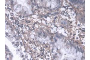DAB staining on IHC-P; Samples: Human Liver cancer Tissue (PIIINP antibody  (AA 24-153))