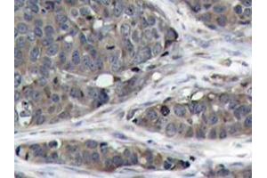 Immunohistochemistry analysis of NFκB-p105/p50 antibody in paraffin-embedded human breast carcinoma tissue.