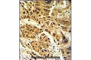 Formalin-fixed and paraffin-embedded human hepatocarcinoma with LPIN2 Antibody (Center), which was peroxidase-conjugated to the secondary antibody, followed by DAB staining. (Lipin 2 antibody  (AA 262-288))