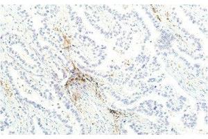Immunohistochemistry of paraffin-embedded Human lung carcinoma tissue using JAK1 Monoclonal Antibody at dilution of 1:200. (JAK1 antibody)