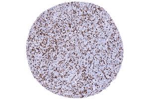 B CLL containing numerous CD4 positive lymphocytes (Recombinant CD4 antibody  (AA 216-396))