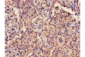 Immunohistochemistry of paraffin-embedded human lung cancer using ABIN7163589 at dilution of 1:100 (CD42a antibody  (AA 17-88))