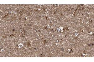 ABIN6279508 at 1/100 staining Human brain cancer tissue by IHC-P. (ICAM5 antibody)