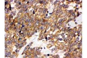 DDAH2 was detected in paraffin-embedded sections of human lung cancer tissues using rabbit anti- DDAH2 Antigen Affinity purified polyclonal antibody (Catalog # ) at 1 µg/mL. (DDAH2 antibody  (C-Term))