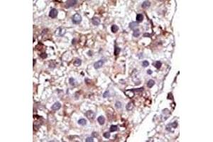 IHC analysis of FFPE human hepatocarcinoma tissue stained with the SPHK2 antibody (SPHK2 antibody  (AA 1-30))