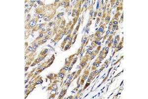 Immunohistochemistry of paraffin-embedded human liver cancer using IKBKAP Rabbit pAb (ABIN6130369, ABIN6142278, ABIN6142279 and ABIN6214265) at dilution of 1:100 (40x lens).