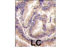 Formalin-fixed and paraffin-embedded human lung carcinoma tissue reacted with STK9 Antibody (C-term) (ABIN391362 and ABIN2841381) , which was peroxidase-conjugated to the secondary antibody, followed by DAB staining. (CDKL5 antibody  (C-Term))