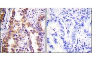 Immunohistochemistry analysis of paraffin-embedded human lung carcinoma tissue, using Tuberin/TSC2 (Ab-939) Antibody.