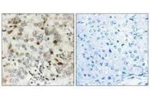 Immunohistochemistry analysis of paraffin-embedded human breast carcinoma tissue using CGREF1 antibody. (CGREF1 antibody  (C-Term))