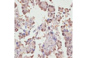 Immunohistochemistry of paraffin-embedded human lung cancer using Y antibody (ABIN6132789, ABIN6150317, ABIN6150322 and ABIN6215136) at dilution of 1:100 (40x lens). (YAP1 antibody  (AA 155-504))