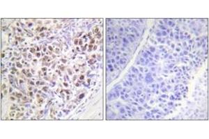 Immunohistochemistry analysis of paraffin-embedded human liver carcinoma, using AurB (Phospho-Thr232) Antibody. (Aurora Kinase B antibody  (pThr232))