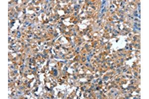The image on the left is immunohistochemistry of paraffin-embedded Human thyroid cancer tissue using ABIN7191907(PLA2G6 Antibody) at dilution 1/15, on the right is treated with synthetic peptide. (PLA2G6 antibody)
