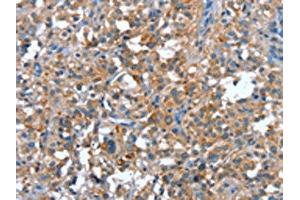 The image on the left is immunohistochemistry of paraffin-embedded Human thyroid cancer tissue using ABIN7191907(PLA2G6 Antibody) at dilution 1/15, on the right is treated with synthetic peptide. (PLA2G6 antibody)