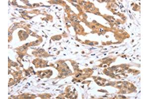 The image on the left is immunohistochemistry of paraffin-embedded Human ovarian cancer tissue using ABIN7192042(PSPN Antibody) at dilution 1/25, on the right is treated with synthetic peptide. (Persephin antibody)