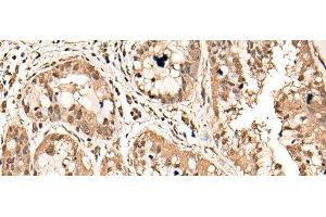 Immunohistochemistry of paraffin-embedded Human liver cancer tissue using ATAD3A Polyclonal Antibody at dilution of 1:40(x200) (ATAD3A antibody)