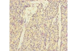 Immunohistochemistry of paraffin-embedded human ovarian cancer using ABIN7170910 at dilution of 1:100 (SUCLA2 antibody  (AA 1-180))
