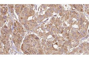 ABIN6276463 at 1/100 staining Human Melanoma tissue by IHC-P. (Endothelin 3 antibody  (C-Term))