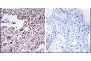 Immunohistochemistry analysis of paraffin-embedded human breast carcinoma tissue, using MUC1 Antibody. (MUC1 antibody  (AA 1191-1240))
