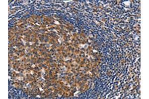 The image on the left is immunohistochemistry of paraffin-embedded Human tonsil tissue using ABIN7128916(CEP97 Antibody) at dilution 1/40, on the right is treated with fusion protein. (CEP97 antibody)