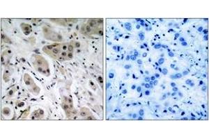 Immunohistochemistry analysis of paraffin-embedded human breast carcinoma, using Akt (Phospho-Ser473) Antibody. (AKT1 antibody  (pSer473))