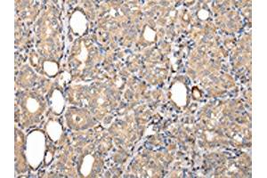 The image on the left is immunohistochemistry of paraffin-embedded Human thyroid cancer tissue using ABIN7128011(SERPINA7 Antibody) at dilution 1/25, on the right is treated with fusion protein. (SERPINA7 antibody)