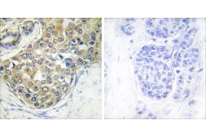 Immunohistochemistry analysis of paraffin-embedded human breast carcinoma tissue using ACK1 (Phospho-Tyr284) antibody. (TNK2 antibody  (pTyr284))