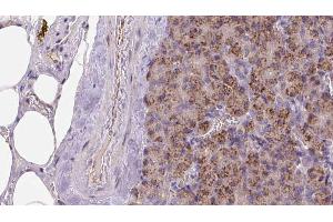 ABIN6273259 at 1/100 staining Human pancreas cancer tissue by IHC-P. (KIDINS220 antibody  (Internal Region))