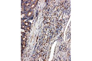 Anti-CD163 antibody, IHC(P): Human Intestinal Cancer Tissue