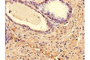 Immunohistochemistry of paraffin-embedded human prostate cancer using ABIN7158308 at dilution of 1:100
