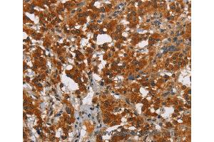 Immunohistochemistry of Human thyroid cancer using SMAD9 Polyclonal Antibody at dilution of 1:40