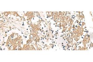 Immunohistochemistry of paraffin-embedded Human lung cancer tissue using HNF1A Polyclonal Antibody at dilution of 1:25(x200) (HNF1A antibody)