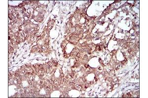 Immunohistochemical analysis of paraffin-embedded cervical cancer tissues using MMEL1 mouse mAb with DAB staining. (MMEL1 antibody  (AA 1-107))
