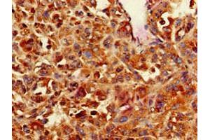 Immunohistochemistry of paraffin-embedded human melanoma using ABIN7146559 at dilution of 1:100 (CNN3 antibody  (AA 2-329))