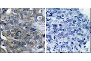Immunohistochemistry analysis of paraffin-embedded human breast carcinoma tissue, using HER2 (Ab-877) Antibody. (ErbB2/Her2 antibody  (AA 851-900))