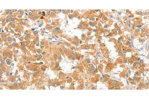 Immunohistochemistry of paraffin-embedded Human thyroid cancer using COL4A3BP Polyclonal Antibody at dilution of 1:60 (COL4A3BP antibody)