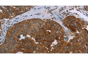 Immunohistochemistry of paraffin-embedded Human ovarian cancer using SNCG Polyclonal Antibody at dilution of 1:60 (SNCG antibody)